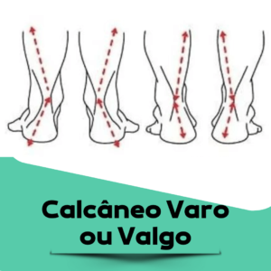 calcaneo-varo-valgo